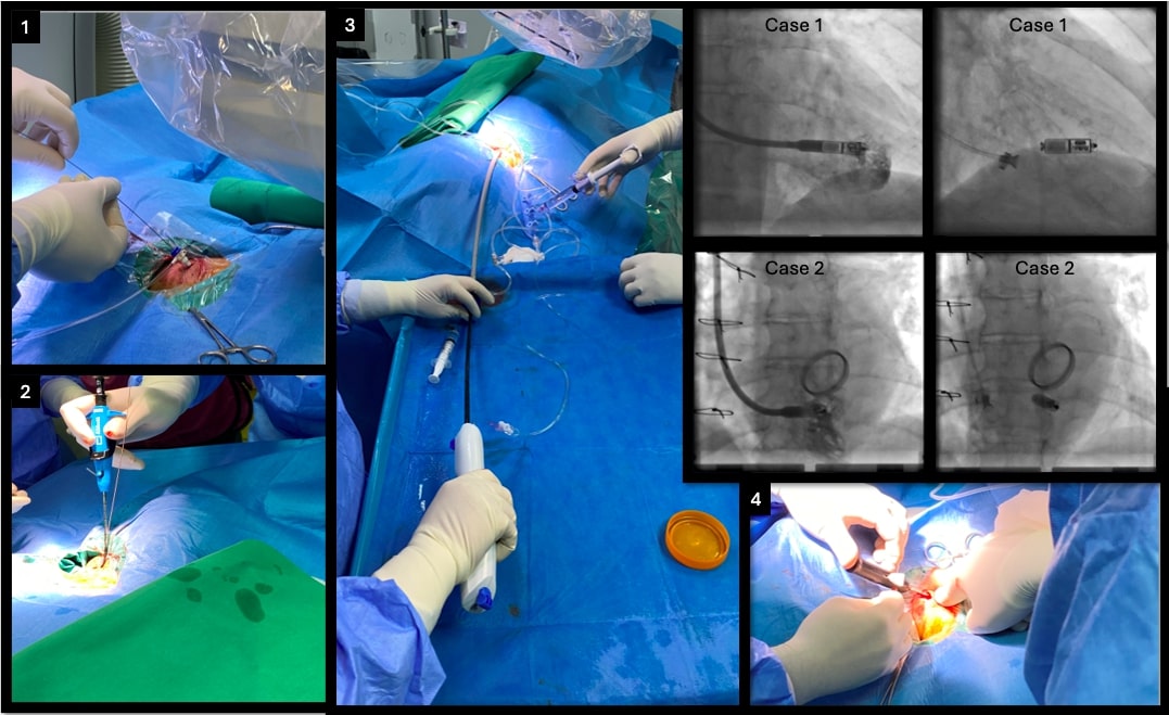 Micra Leadless Pacemaker Implantation via the Right Internal